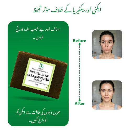 ACNE SOAP